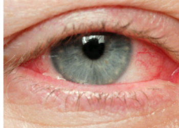 Retinoblastoma, a very dangerous diseases that cause total blindness. Learn it and prevent it.