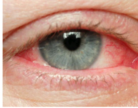 Retinoblastoma, a very dangerous diseases that cause total blindness. Learn it and prevent it.