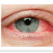 Retinoblastoma, a very dangerous diseases that cause total blindness. Learn it and prevent it.