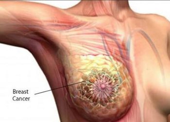 Breast cancer , a deadly cancer ,but it can be prevented