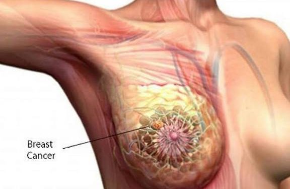 Breast cancer , a deadly cancer ,but it can be prevented