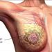 Breast cancer , a deadly cancer ,but it can be prevented