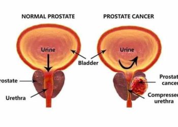 HEALTH,Prostate Cancer is killing so many men, let us know about its causes, and prevention tips.