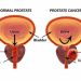 HEALTH,Prostate Cancer is killing so many men, let us know about its causes, and prevention tips.