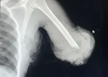 BREAKING NEWS, ETHIOPIA: Doctors miraculously managed to reattach a young man’s totally cut-off arm