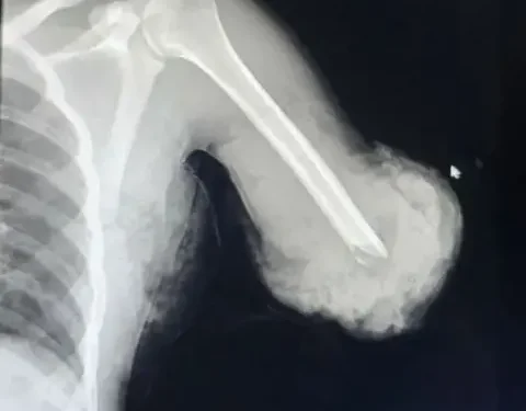 BREAKING NEWS, ETHIOPIA: Doctors miraculously managed to reattach a young man’s totally cut-off arm